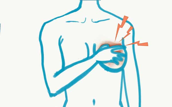 nipple discharge other than milk bloody discharge nipple discharge other than milk lymph discharge